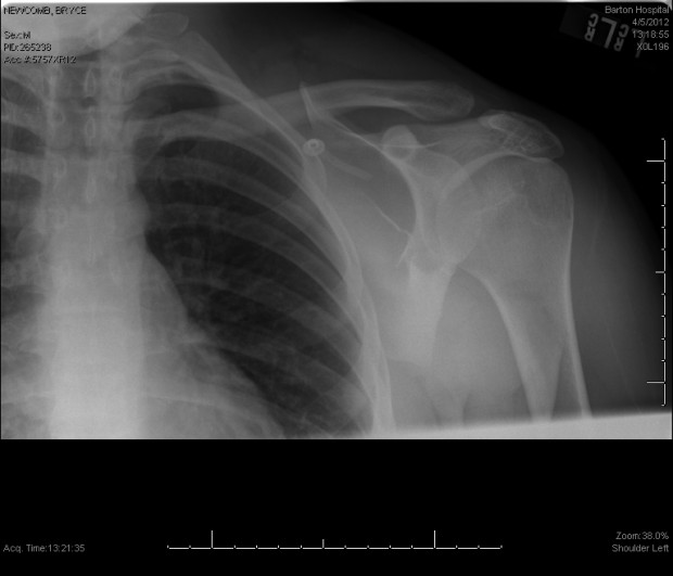 Fractured scapula. Crack below collarbone