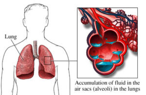 lungs with HAPE