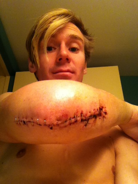 Left side is surgery, right side is where the bone literally made a break for it