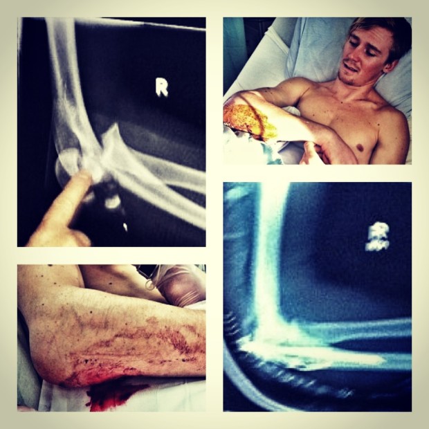X-Rays and arm status before and after surgery