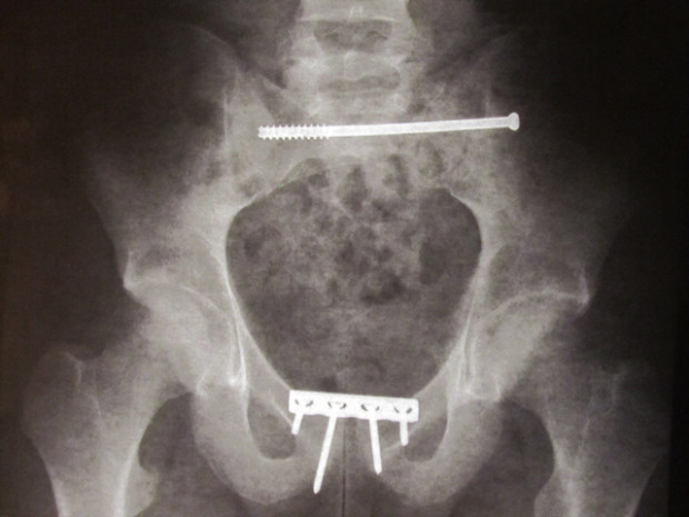 james heim pelvis