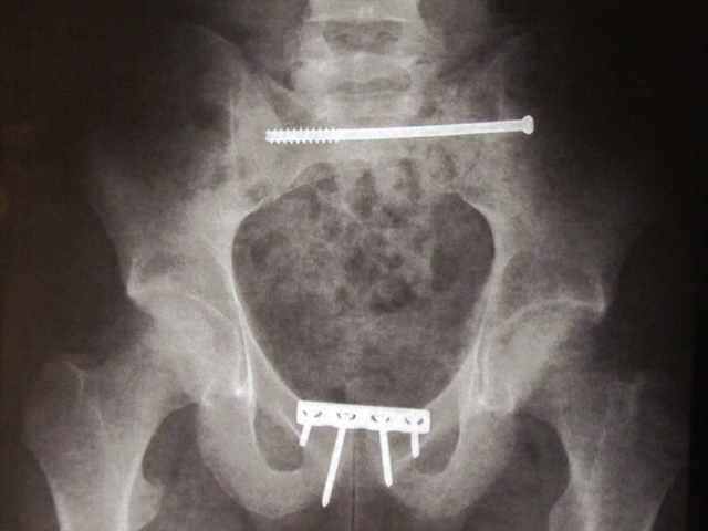 james heim pelvis