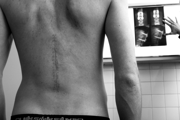 Candide Thovex has some serious hardware in his spine...  