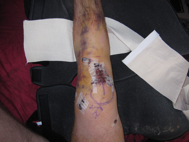 Post ACL surgery... so fun...
