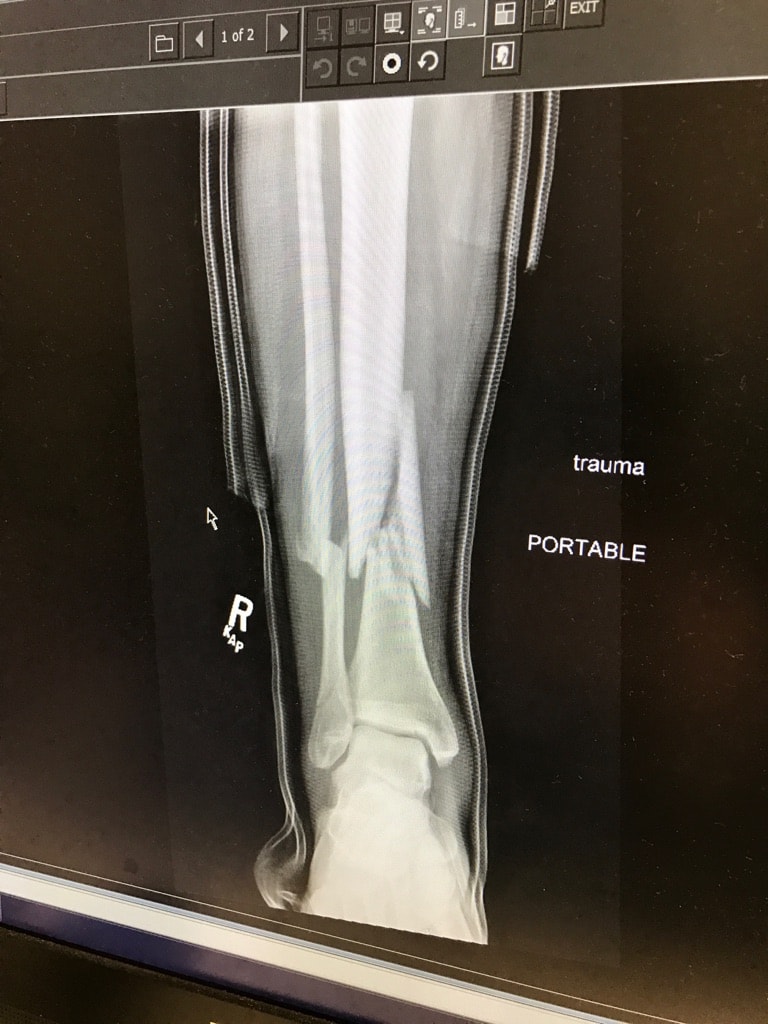 Jeremey Jones' leg injury. image: gofundme.com