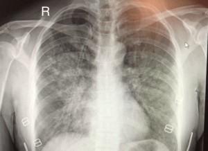 X-ray of a HAPE patient