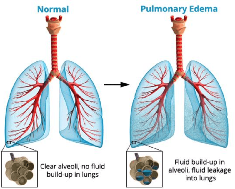 lungs undergoing pulmonary edema