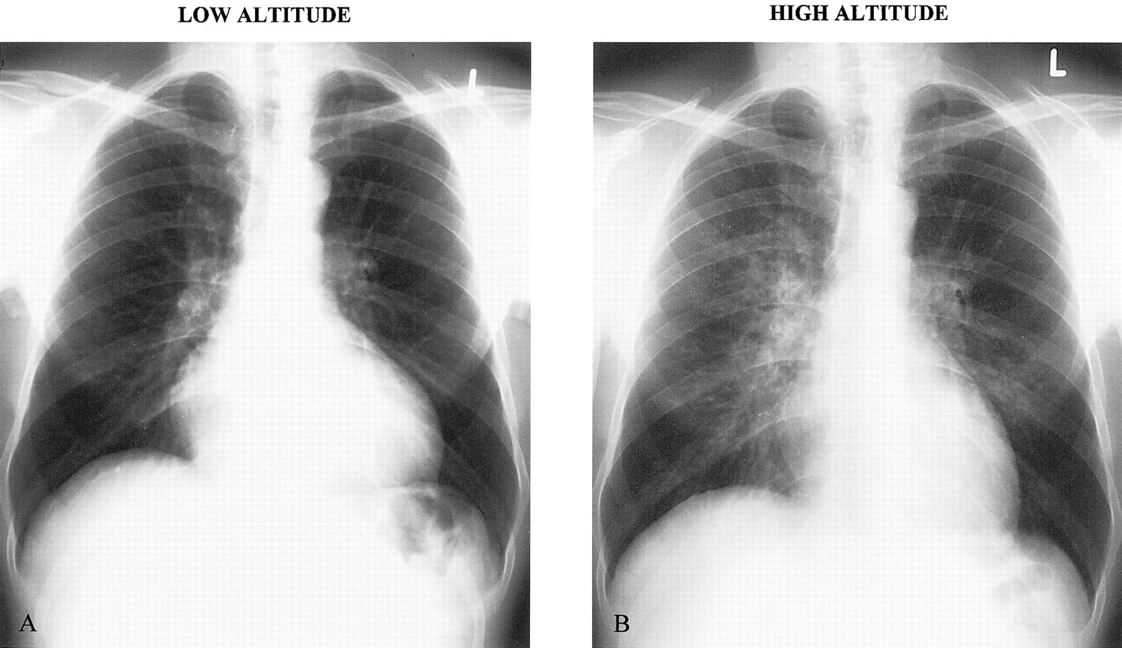 A comparison of healthy lungs and a set of lungs that are affected by HAPE.