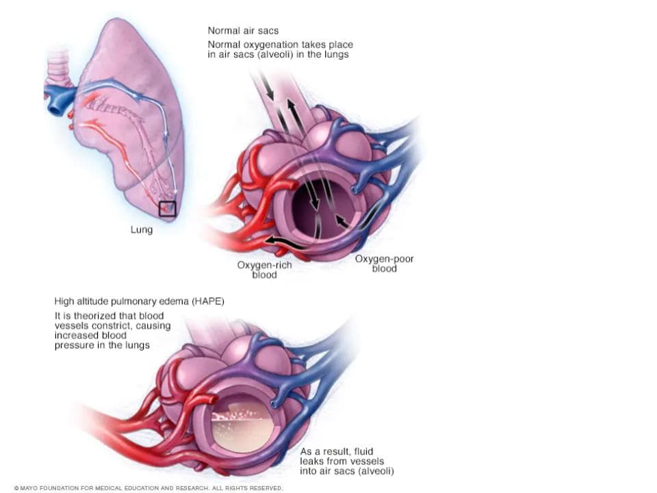 restriction of blood vessels causing fluid build-up