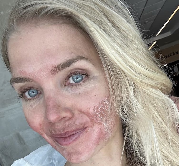Skin damage